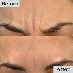 BOTOX