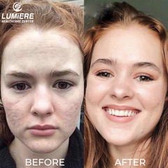 ACNE SCARS