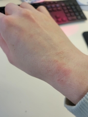 CHẨN ĐOÁN VÀ ĐIỀU TRỊ VIÊM DA TIẾP XÚC DỊ ỨNG (ALLERGIC CONTACT DERMATITIS)