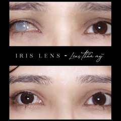 [LOẠI TỐT] Lens thẩm mỹ che khuyết điểm Angel Eyes dành cho mắt bị đục thủy tinh thế, kéo mây, cườm - GSLENS