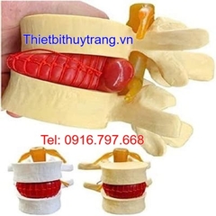 Mô Hình Thoát Vị Đĩa Đệm TVDD
