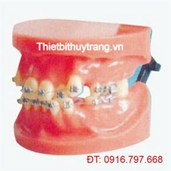 MÔ HÌNH CHỈNH NHA CỐ ĐỊNH (TRẬT KHỚP) GD/B10038