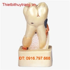 MÔ HÌNH GIẢI PHẪU BỆNH RĂNG MIỆNG GD/B10008