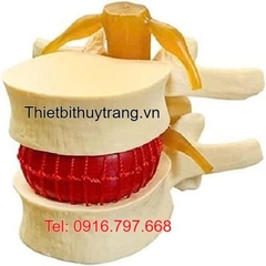 Mô Hình Thoát Vị Đĩa Đệm TVDD