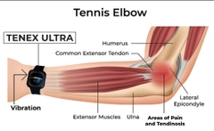 Đồng hồ giảm chấn Tenex Elbow Shock Absorber