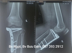 Phẫu thuật kết hợp xương mâm chày ít xâm lấn+ nội soi khớp gối
