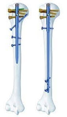 Phẫu thuật kết hợp xương đinh nội tủy thân xương cánh tay