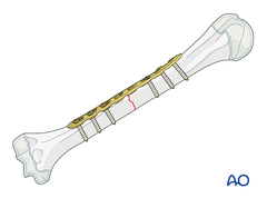 Phẫu thuật kết hợp xương nẹp vis thân xương cánh tay