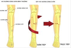 Phẫu thuật kết hợp xương bằng nẹp vis thân xương chày