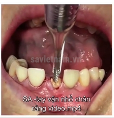 Cây vặn vis nhổ chân răng