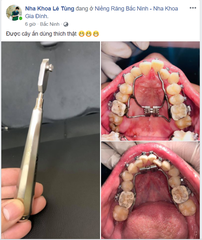 Cây ấn band chỉnh nha (Cây ấn band thép Đức)