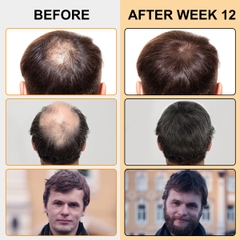 Bọt giúp mọc tóc với Biotin hỗ trợ mọc lại tóc để tóc dày Elaimei Hair Growth Foam