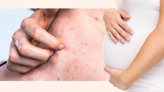 Giải đáp vấn đề: Bà bầu có dùng kem trị mụn được không?