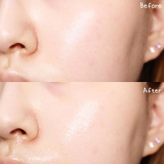 Bộ sản phẩm Toner, Serum, Kem dưỡng Derladie giảm mụn, thu nhỏ lỗ chân lông cho da dầu mụn