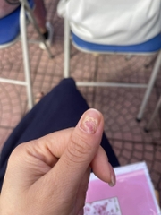 Kem bôi nấm á sừng- nấm móng-viêm da cơ địa nội địa Hàn Quốc