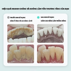 Máy lấy cao răng Dr.Bei T3