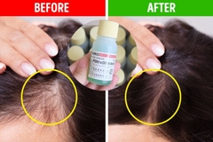 Tinh chất bôi kích thích mọc tóc Sato Arovics Solutions 5% thảo dược 30ml