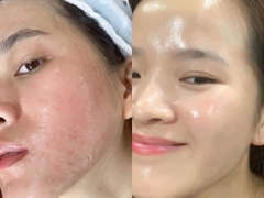 Mặt Nạ Hỗ Trợ Cấp Nước Chuyên Sâu Sur.Medic+ Super Hyaluronic 100™ Aqua Mask 30g