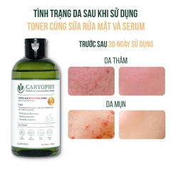 Nước Hoa Hồng Ngừa Mụn Kiềm Dầu Giảm Thâm Caryophy Portulaca Toner