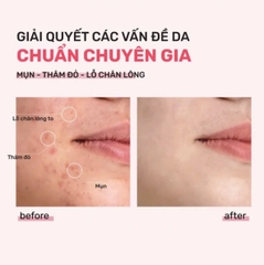Serum Giảm Mụn, Mờ Thâm Đỏ, Thu Nhỏ LCL Derladie Laboratoire Pore Tightening Ampoule Niacinamide 20% + Zic PCA 1% 30ml