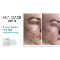 Viên Uống Hỗ Trợ Giảm Mụn Aknicare Combi