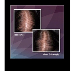 [CHÍNH HÃNG MỸ] Dung Dịch Mọc Tóc Men's Rogaine Extra Strength 5% Minoxidil