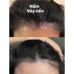 [CHÍNH HÃNG MỸ] Bộ Sưu Tập Dầu Gội Trị Gàu Selsun Blue – Giải Pháp Chuyên Biệt Cho Mọi Loại Da Đầu