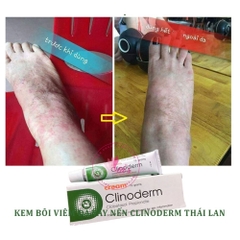 Kem Bôi Ngứa Vảy Nến Thái Lan Clinoderm Cream 15g Viêm Da Cơ Địa, Tổ Đỉa