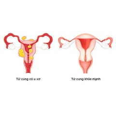 Viên uống U XƠ TỬ CUNG ÍCH NỮ XUÂN Bigfam Hỗ chế hạn chế sự phát triển của u xơ tử cung, u vú lành tính (60 viên)