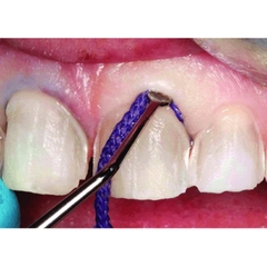 CÂY NHÉT CHỈ CO NƯỚU LOẠI CÓ RĂNG CƯA | Gingival Cord Packers