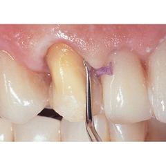 CÂY NHÉT CHỈ CO NƯỚU LOẠI CÓ RĂNG CƯA | Gingival Cord Packers