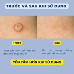 Miếng dán mụn cóc lành tính giúp loại bỏ, ngăn chặn mụn cóc (6 miếng)