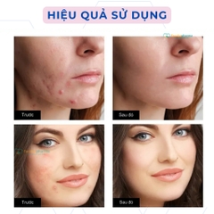 Miếng dán mụn gom cồi trong suốt bảo vệ mụn, che khuyết điểm gói 24 miếng