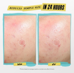 Tinh Chất Chấm Mụn Kiehl's Truly Targeted Acne Clearing Solution 15ml