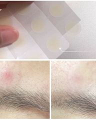 Miếng Dán Mụn Ngày Đêm Derma Angel Acne Patch