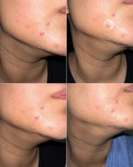 Miếng Dán Mụn Ngày Đêm Derma Angel Acne Patch