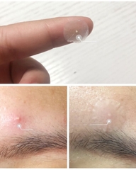 Miếng Dán Mụn Ngày Đêm Derma Angel Acne Patch