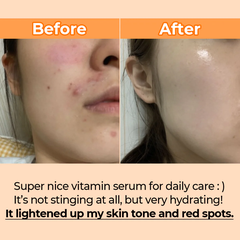 Tinh Chất Numbuzin No.5 Goodbye Blemish Serum 50ml
