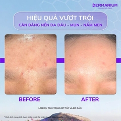 Tinh Chất Giảm Mụn & Nấm Dermarium Liquid Amber