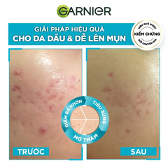 Tinh Chất Garnier Bright Complete Anti-Acne Booster Serum 30ml