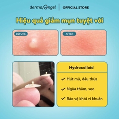 Miếng Dán Mụn Chuyên Biệt Derma Angel Acne Patch 12pcs