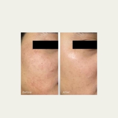 Tinh Chất Ekseption Hyaluronic B5 Mixlab Serum 75ml
