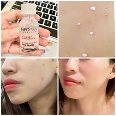 Dung Dịch Chấm Mụn Neogen Dermalogy A-Clear AID Soothing Pink Eraser 15ml – Làm Dịu Nốt Mụn, Hỗ Trợ Giảm Đỏ Và Kiểm Soát Bã Nhờn