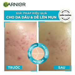 Serum Garnier Giảm Mụn Mờ Thâm Cho Da Dầu, Mụn Bright Complete Anti-Acnes Booster Serum