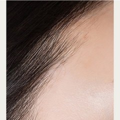 Miếng dán trị mụn Acnes 66 miếng