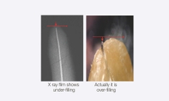 Máy định vị chóp Woodpex III