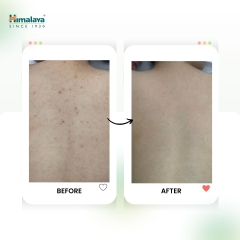 [MUA 6 TẶNG HŨ NGHỆ] Combo 6 xà phòng giảm mụn cơ thể từ lá neem Himalaya Neem & Tumeric Soap (6 BÁNH+ 1 HŨ SRM NGHỆ 14 TUÝP)