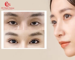 Cấy Mỡ Mắt