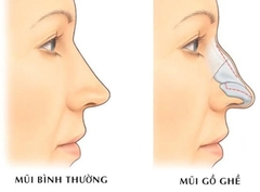 Mài gồ sống mũi