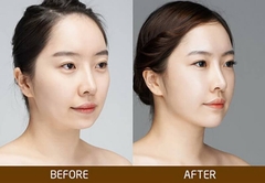 Độn cằm Vline